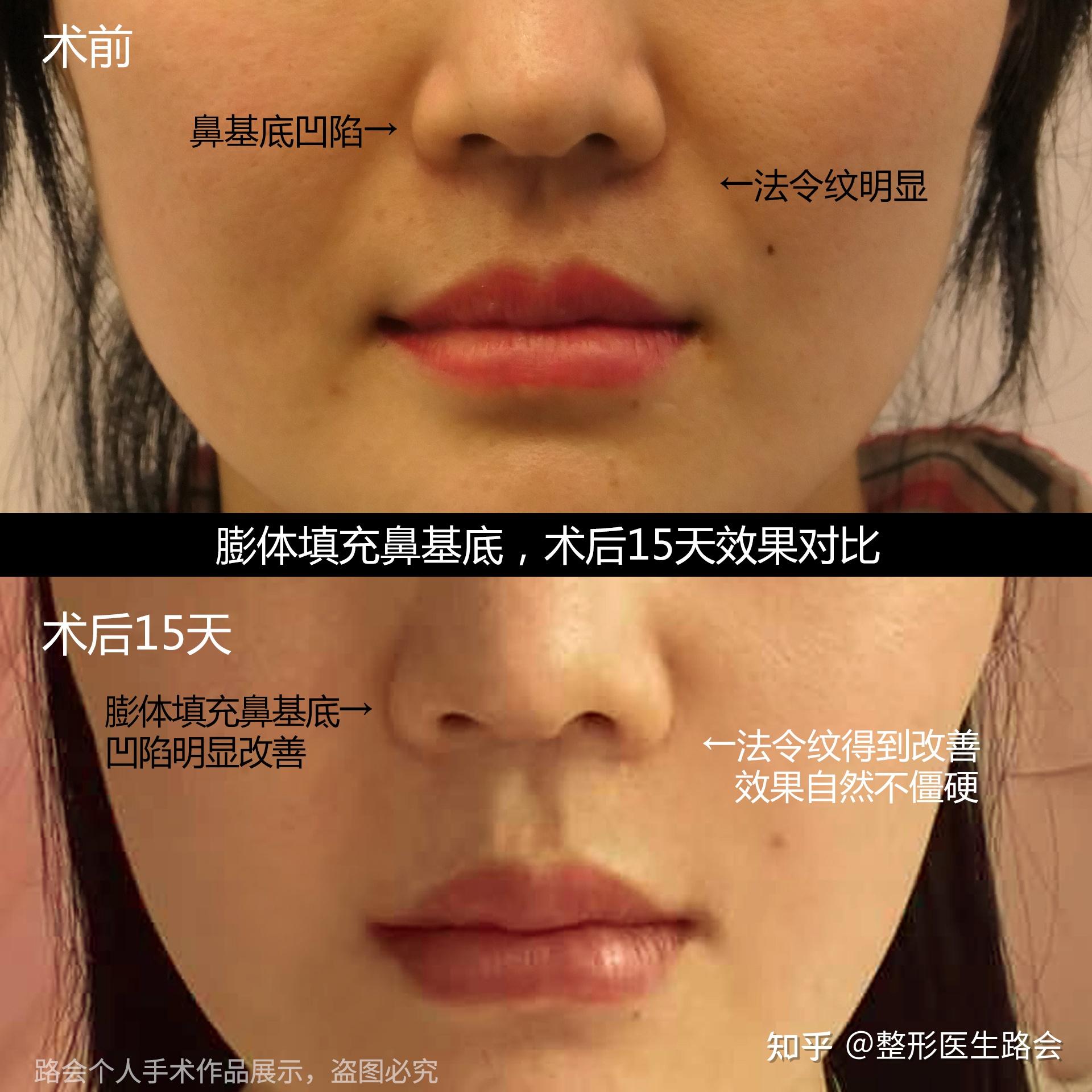 法令纹深、显老10岁,我寻摸了个去法令纹的好法子,试试看吧 - 知乎