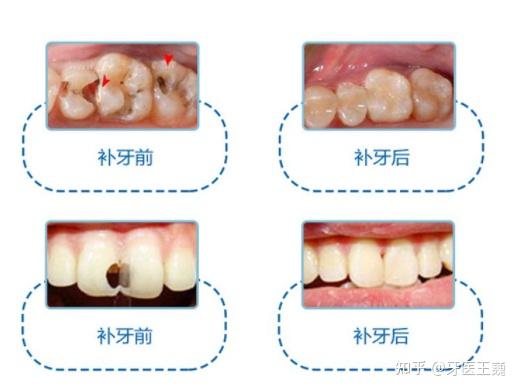 牙齒也會脫礦脫礦怎麼辦