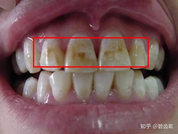 比如: 牙齿过小 牙体明显过小,邻牙与邻牙有间隙 因外伤,磨耗导致的