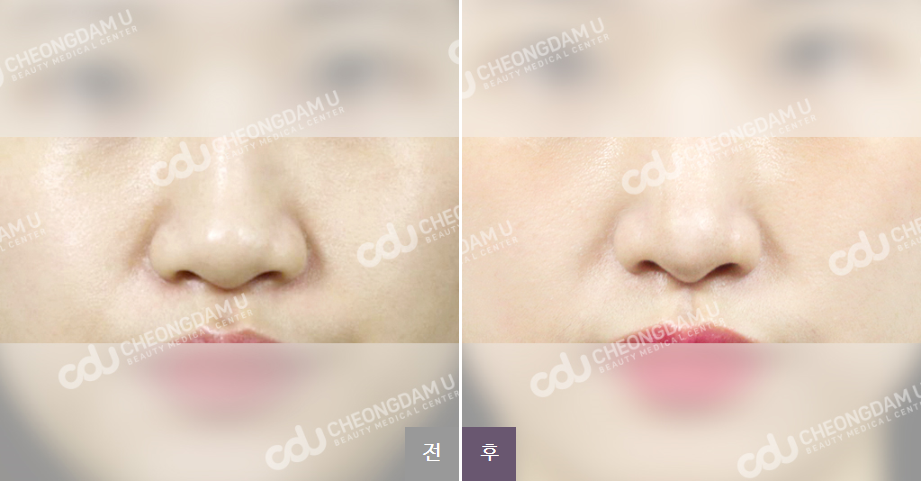 韩国cdu清潭优整形外科医院福鼻整形完美改善木讷讷的圆鼻头