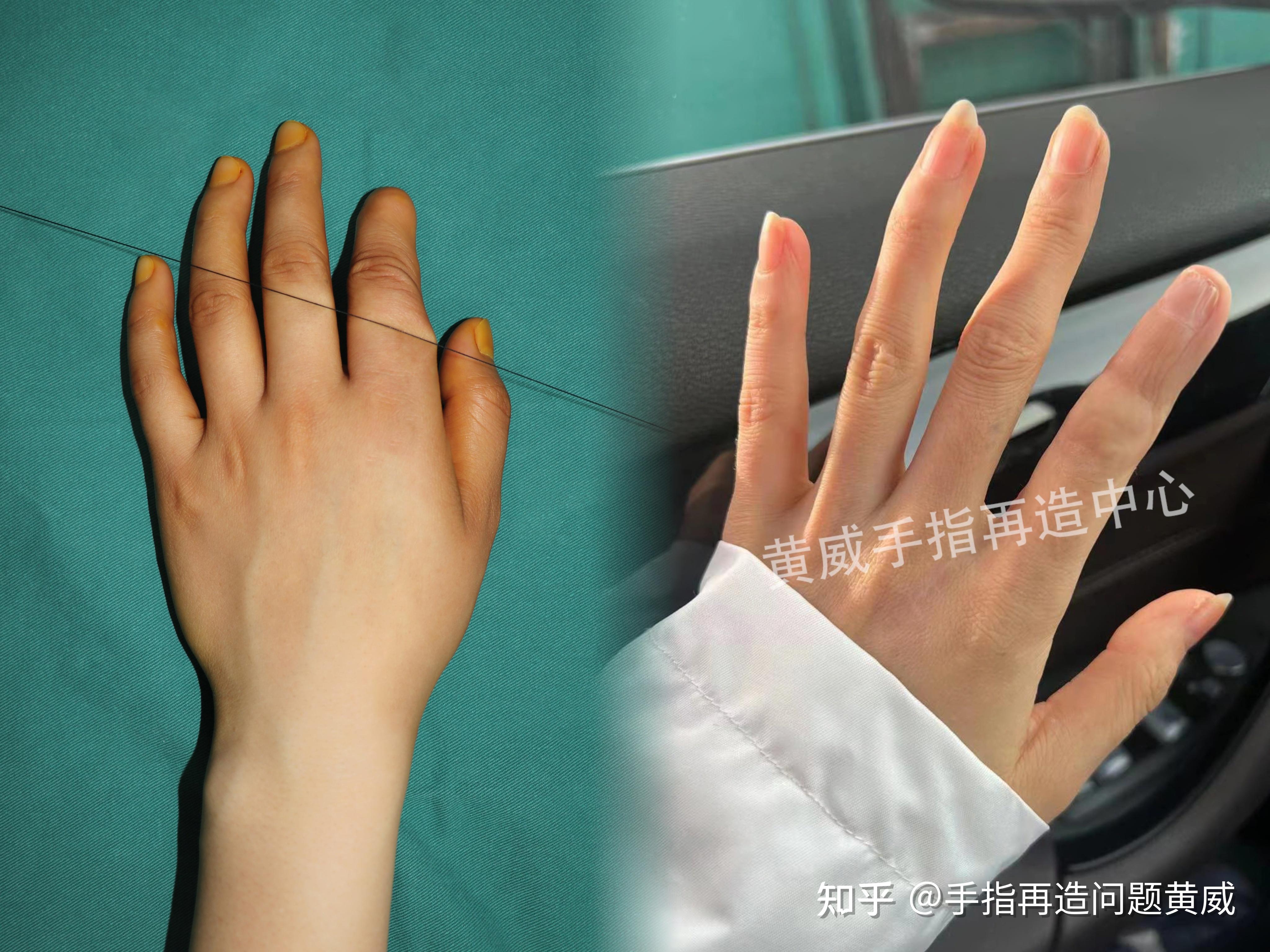 手指屈曲畸形手术图,先天手指屈曲畸形图片,婴儿手指畸形图片(第8页)_大山谷图库