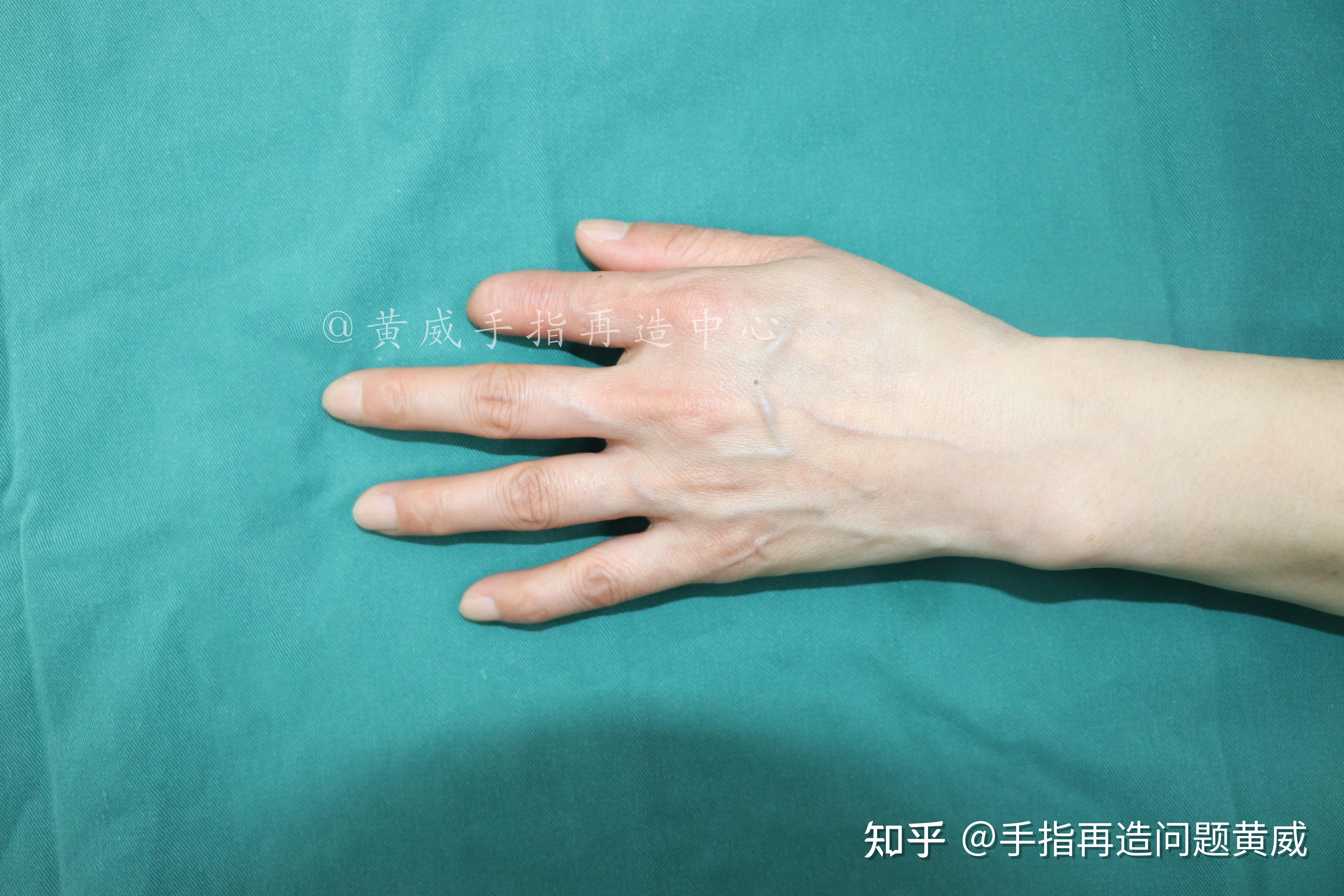 手指断了很多年,可以通过再造恢复完整手指 - 知乎