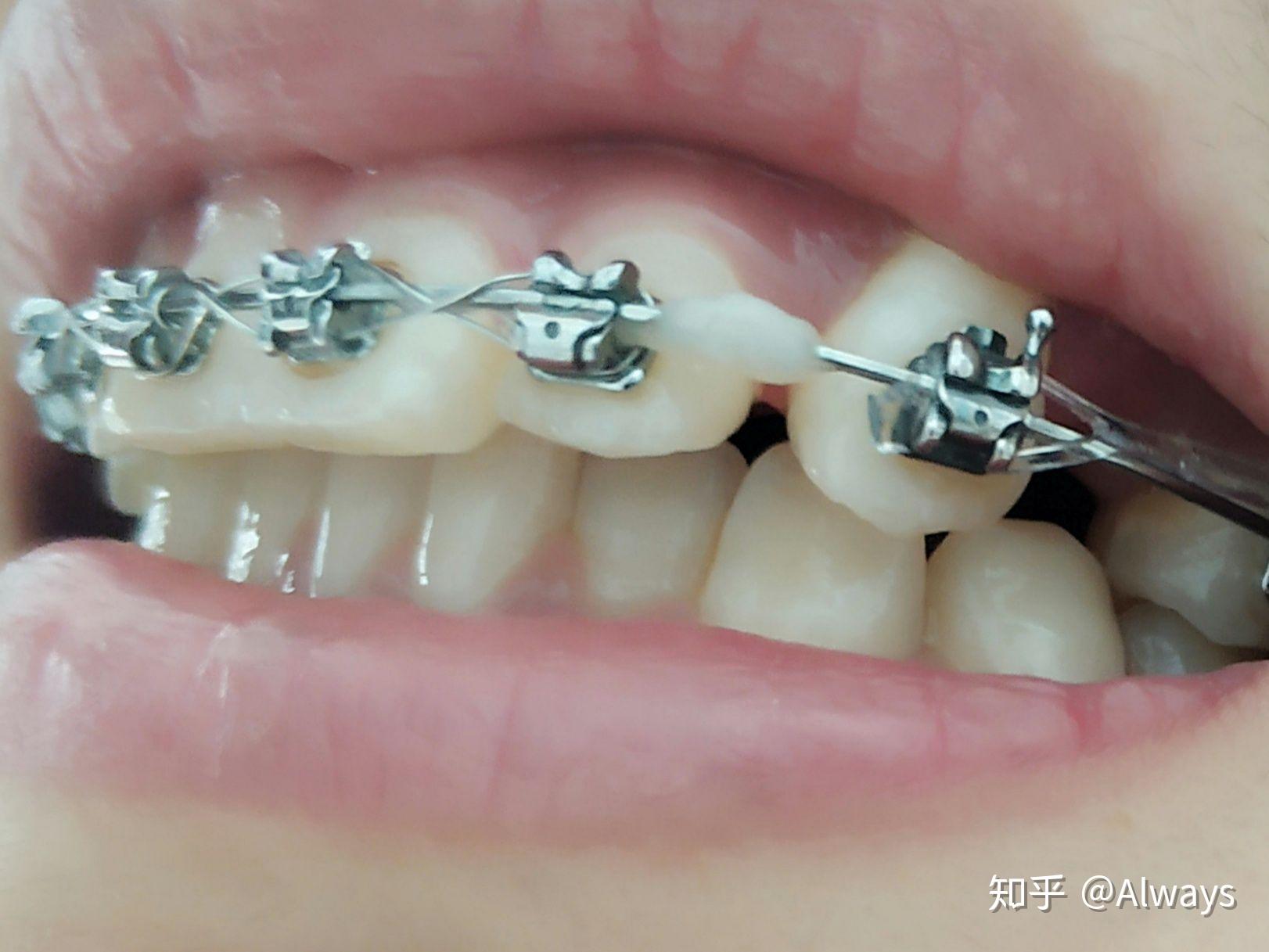 批发牙齿模型 口腔模型 牙齿正畸模型 带托槽正畸牙齿模型-阿里巴巴