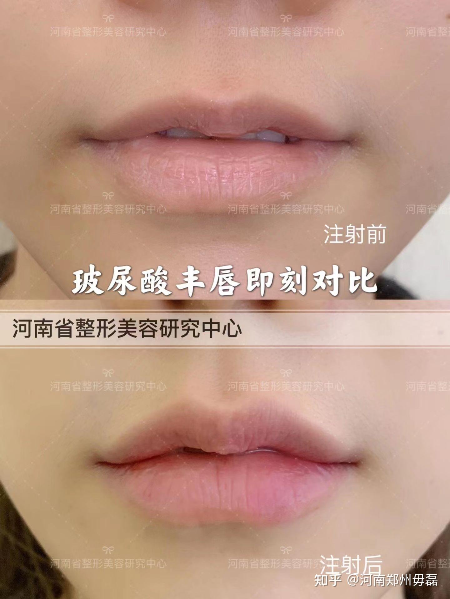 玻尿酸丰下巴,丰唇,填充太阳穴。 - 知乎
