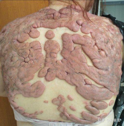 5,对于一些合适部位还可以使用压迫疗法,使瘢痕疙瘩血液供应阻断,使其