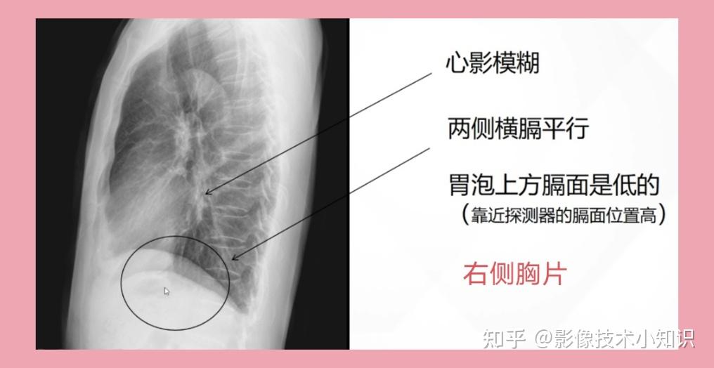 如何识别侧位胸片是左侧位还是右侧位 - 知乎