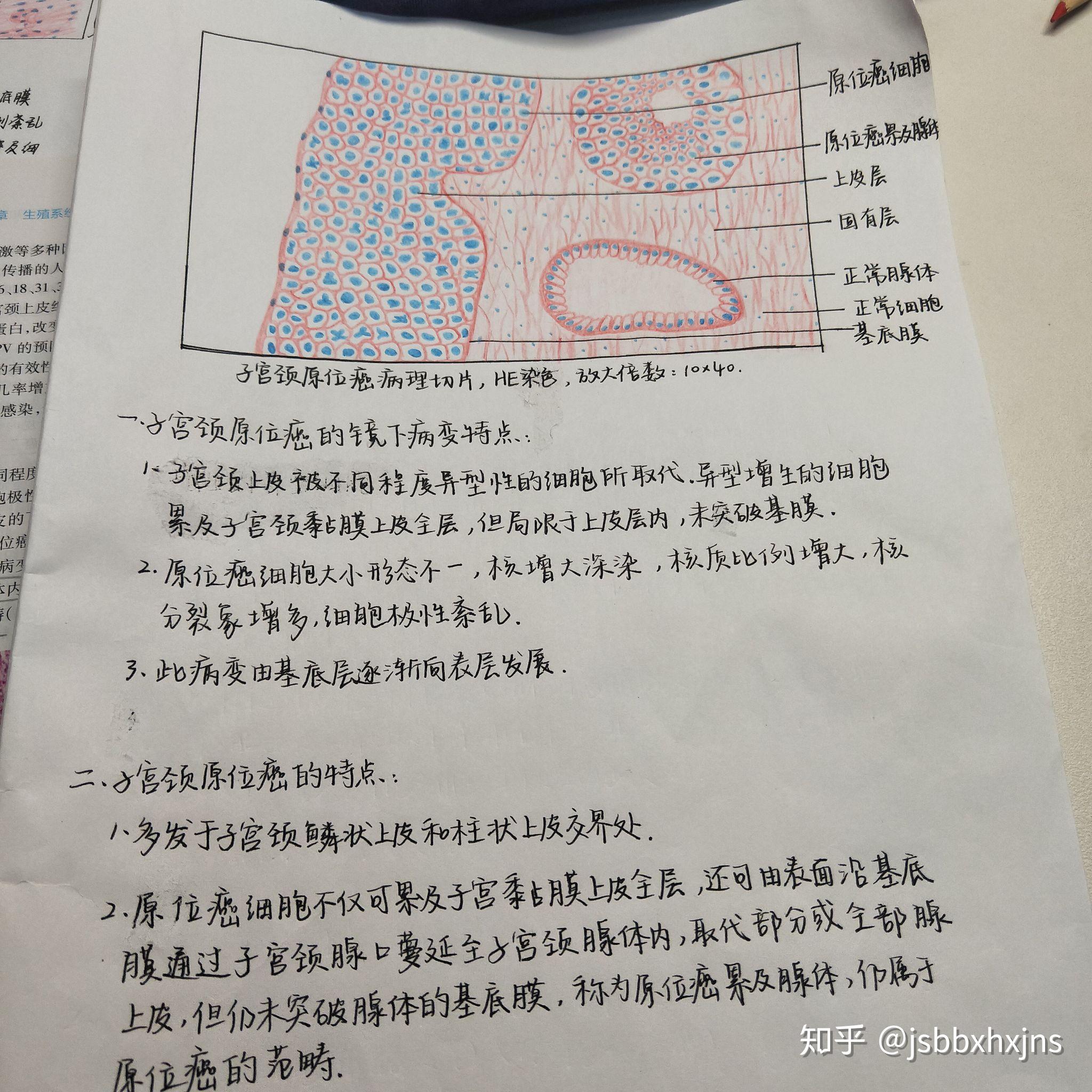 直肠腺癌病理绘图图片