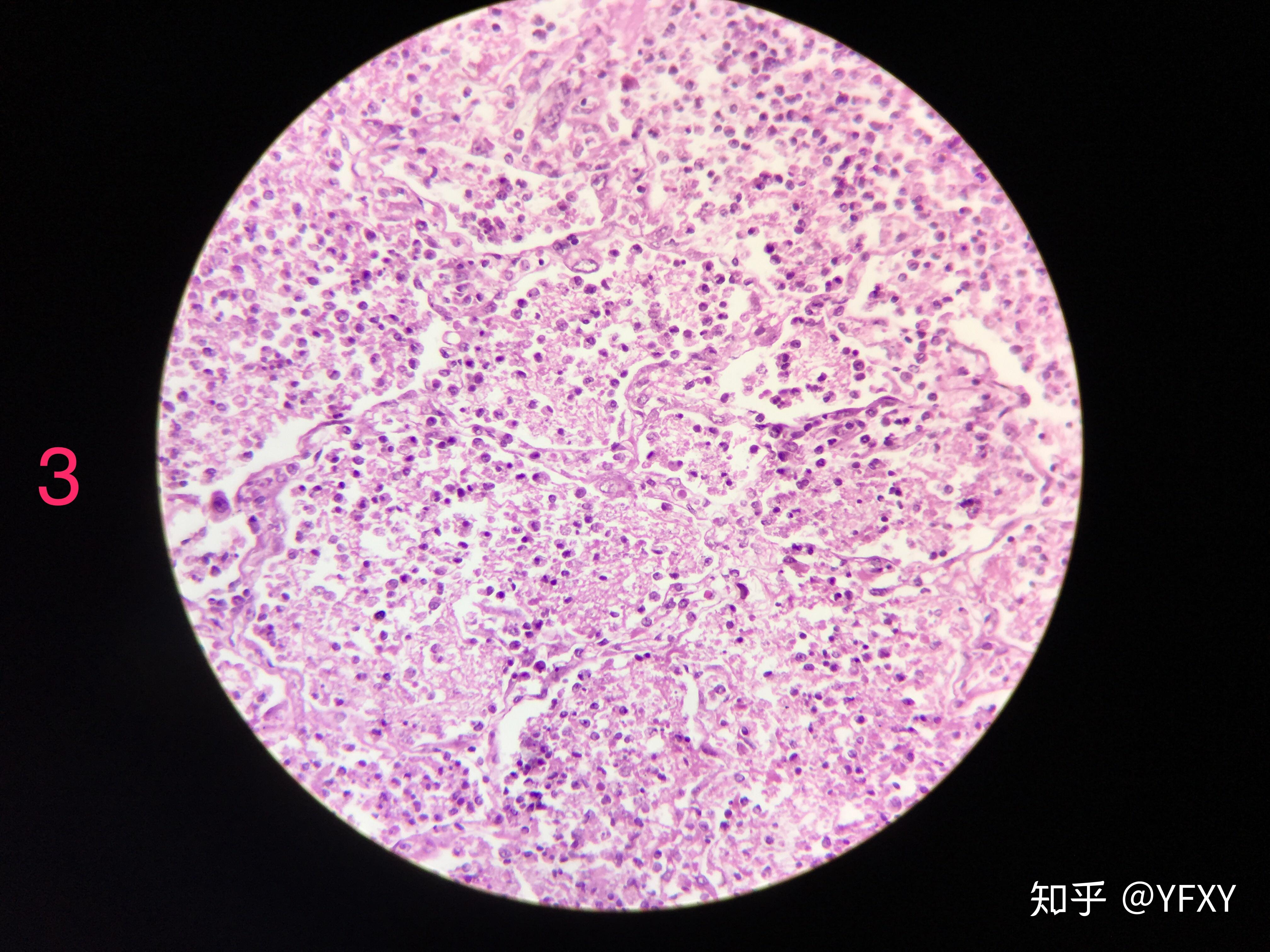 3蜂窝织性阑尾炎ba2慢性肺淤血ba1肉芽组织(仅供参考!