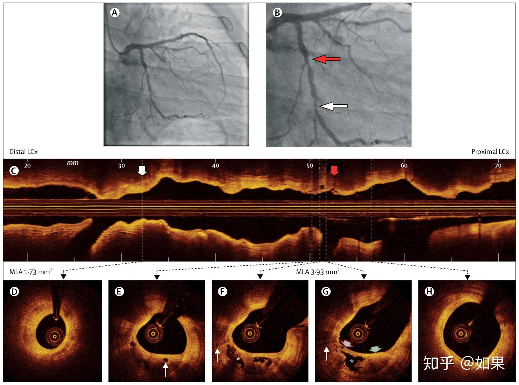 冠脉血管内成像技术ivusoct