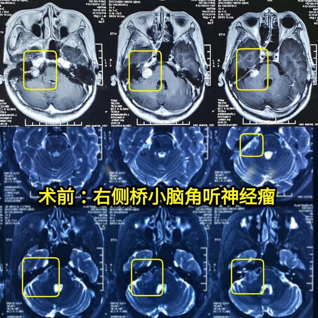 病例分享聽神經瘤微創手術蛛網膜外切除腫瘤完美保留面神經功能