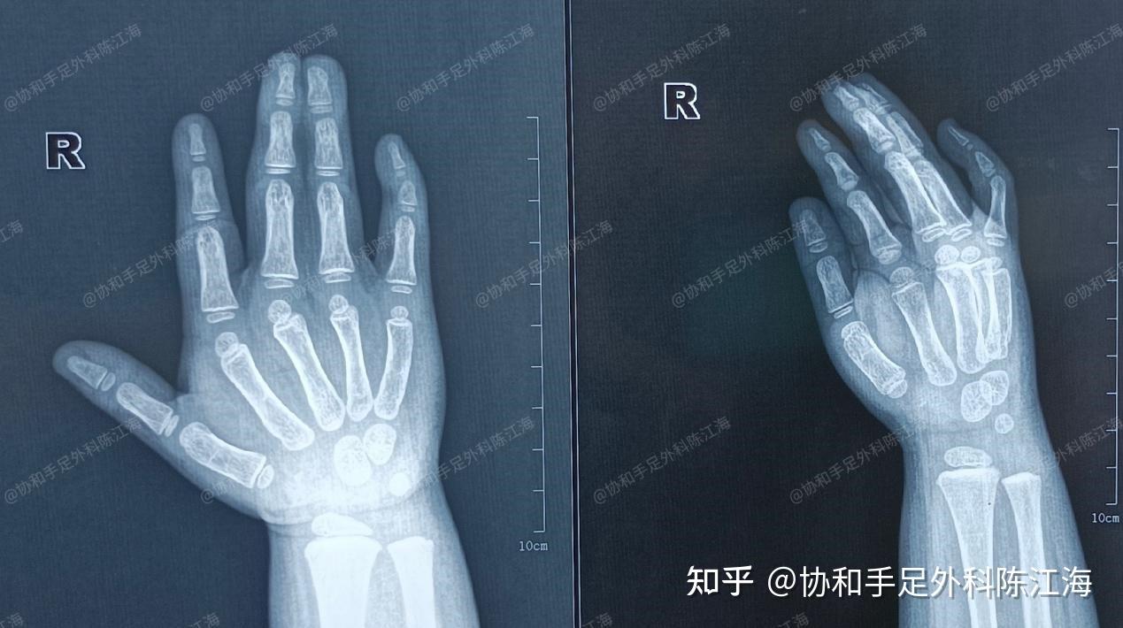 并指免植皮 | 案例13 孩子妈妈:恢复很好,拿东西和力度都没问题 - 知乎