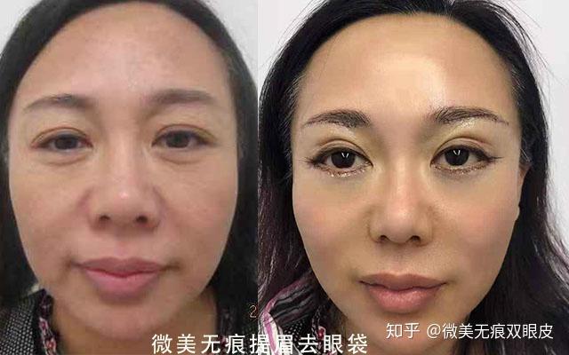 呼和浩特市微美专注无痕双眼皮提眉术