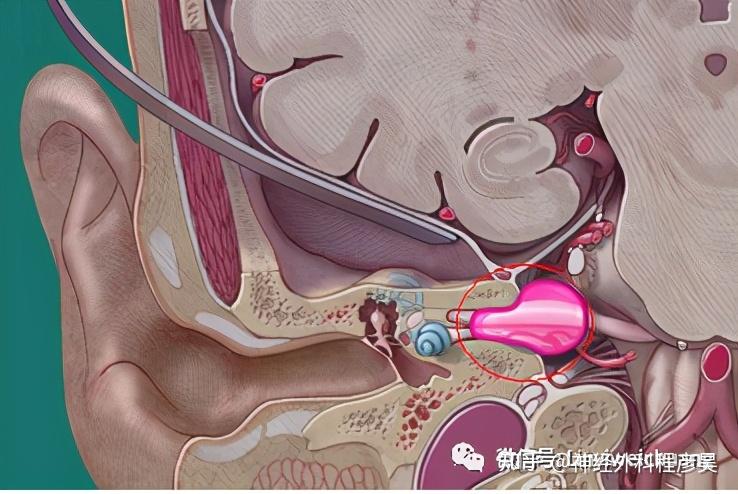切除听神经瘤的手术,就是在耳朵后面开一个一元钱硬币大小的骨窗,相当