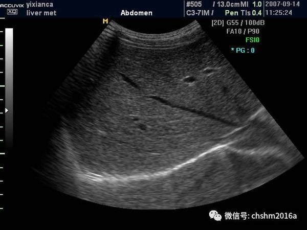 肝中静脉行走于正中裂的后半部和尾状叶内,右半肝与左半肝分界 3.