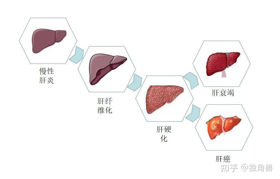 肝纤维化与肝硬化有啥区别?能治好吗?