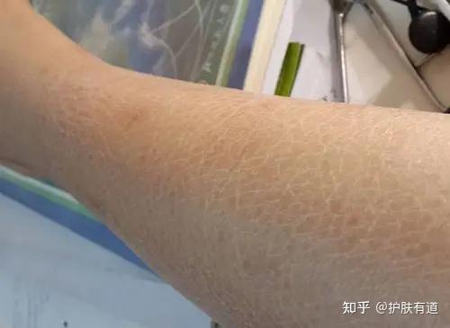 腿部缺水会不会长鸡皮肤(为什么一到冬天腿上就长鸡皮肤)