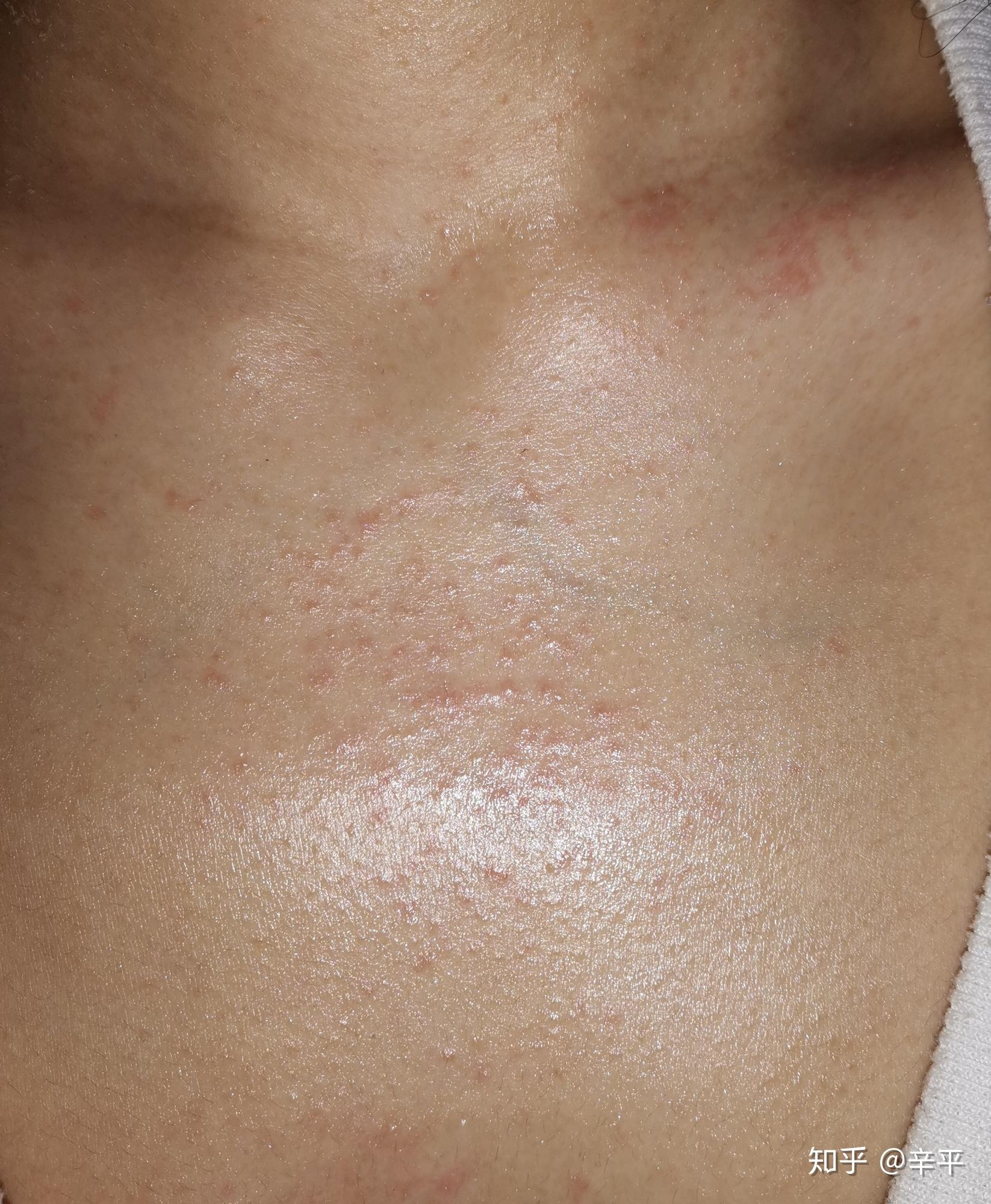 疫情期间去不了医院求大神帮我看看这是疥疮还是过敏的疹子用硫软膏第