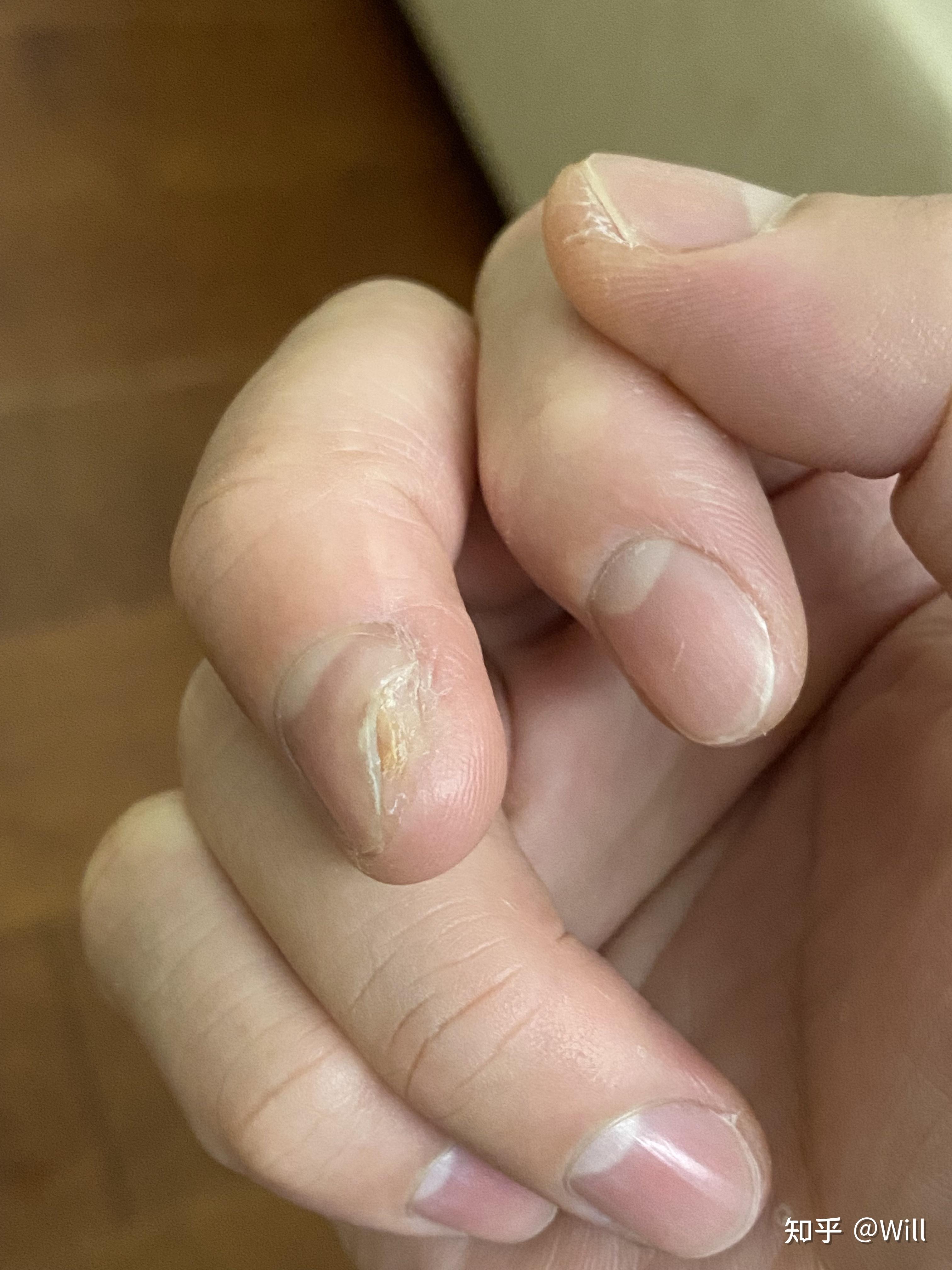 氟尿嘧啶软膏治疗甲周疣 - 知乎