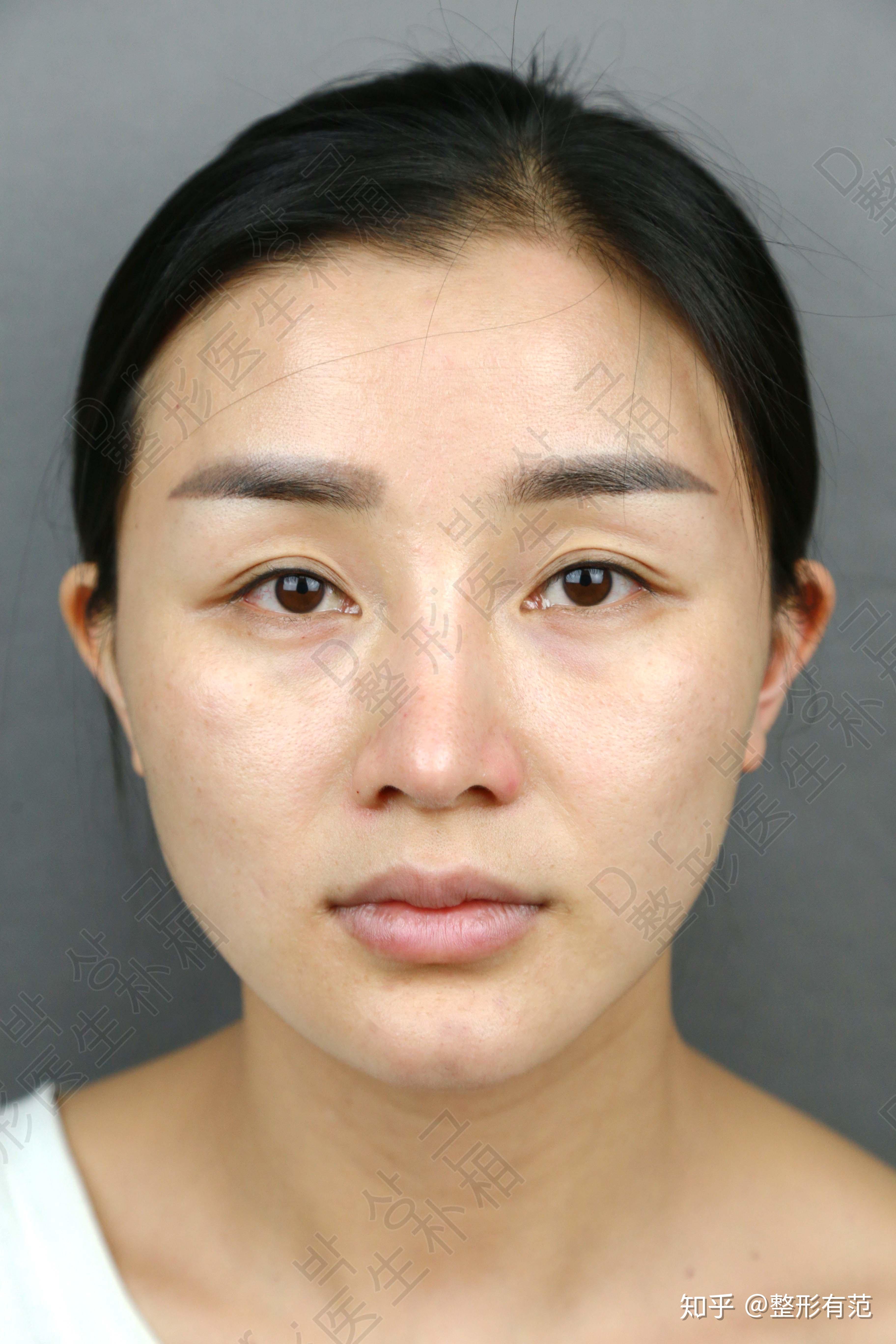 朴相根双眼皮修复做的怎么样?多个眼部手术案例看过瘾