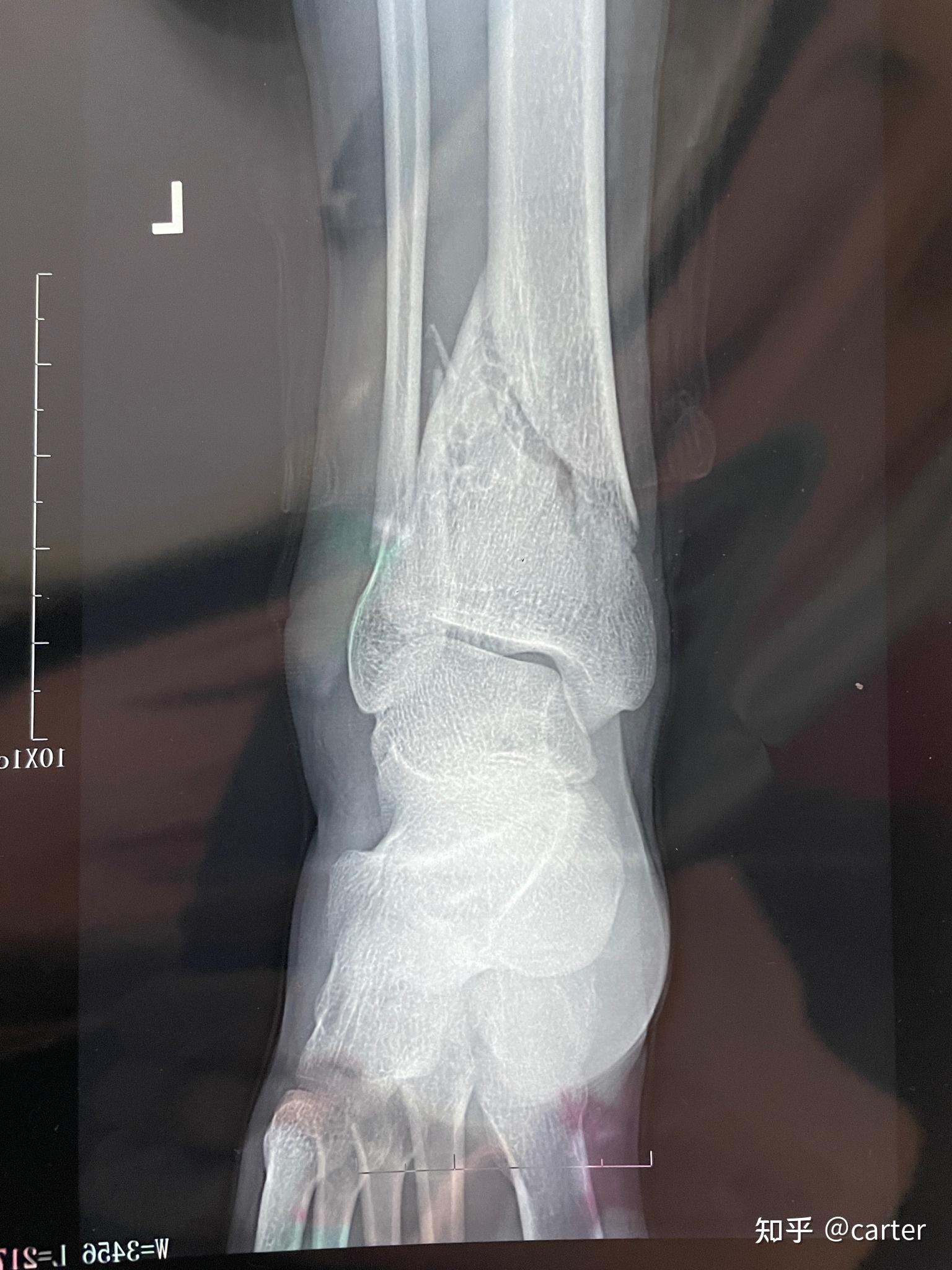 24岁左胫骨腓骨远端骨折及pillon骨折康复记录(有手术