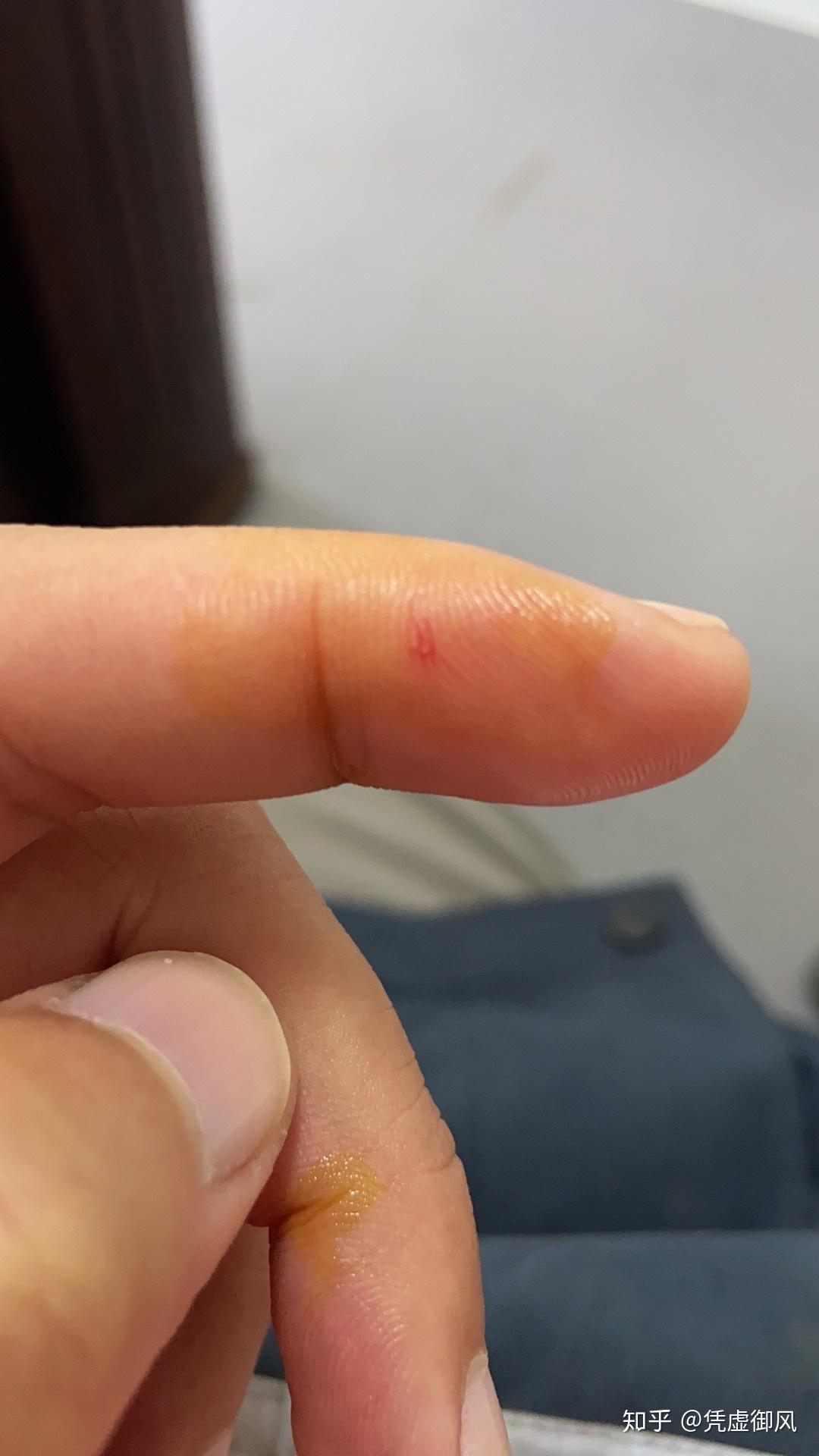 昨天喂猫的时候被小猫咪牙齿给刮到了,出现了一个特别小的口子,就图上