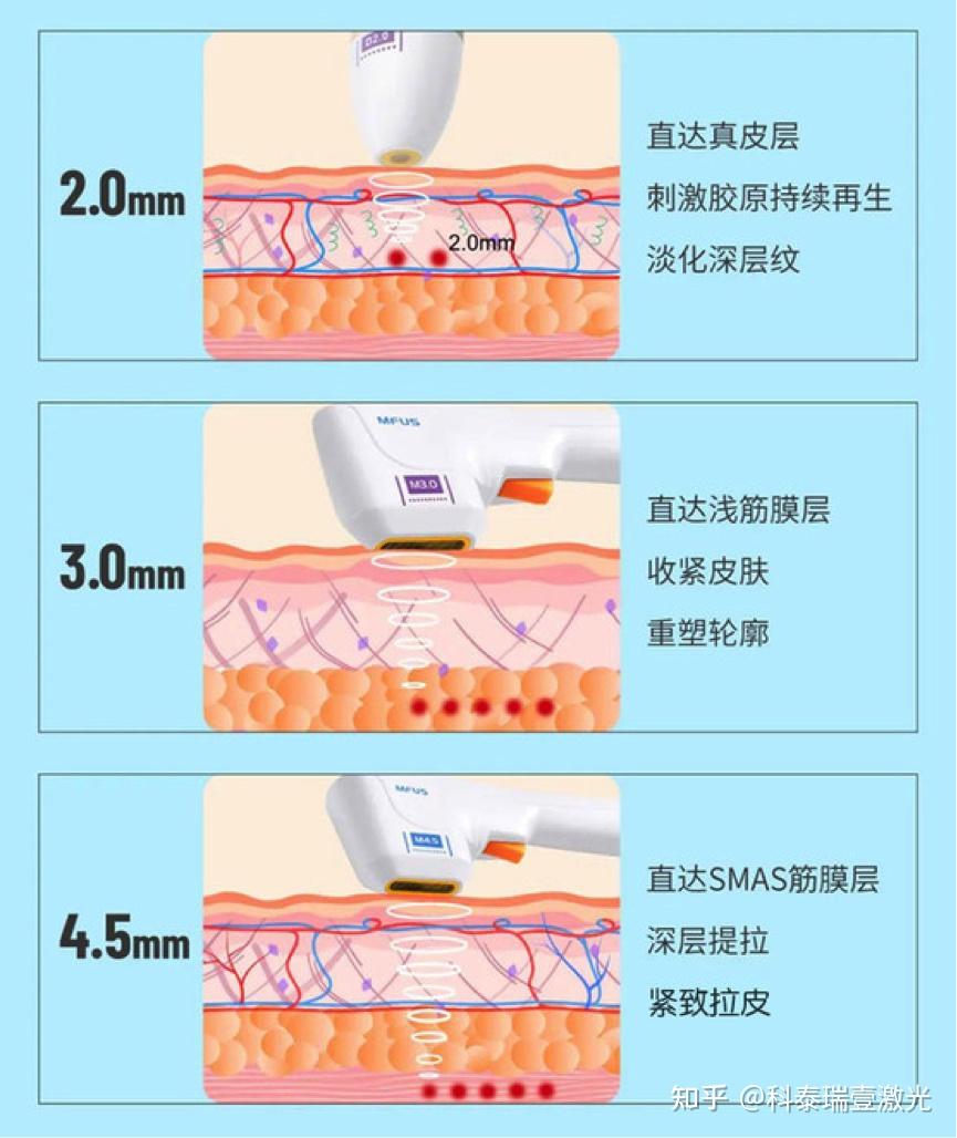 新型抗衰项目 超声炮（全面解析） 知乎