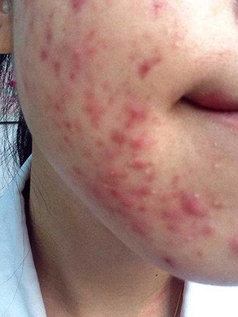 不同痘痘的对策以及红肿痘痘的破解 知乎 不同痘痘的对策以及红肿痘痘的破解 知乎
