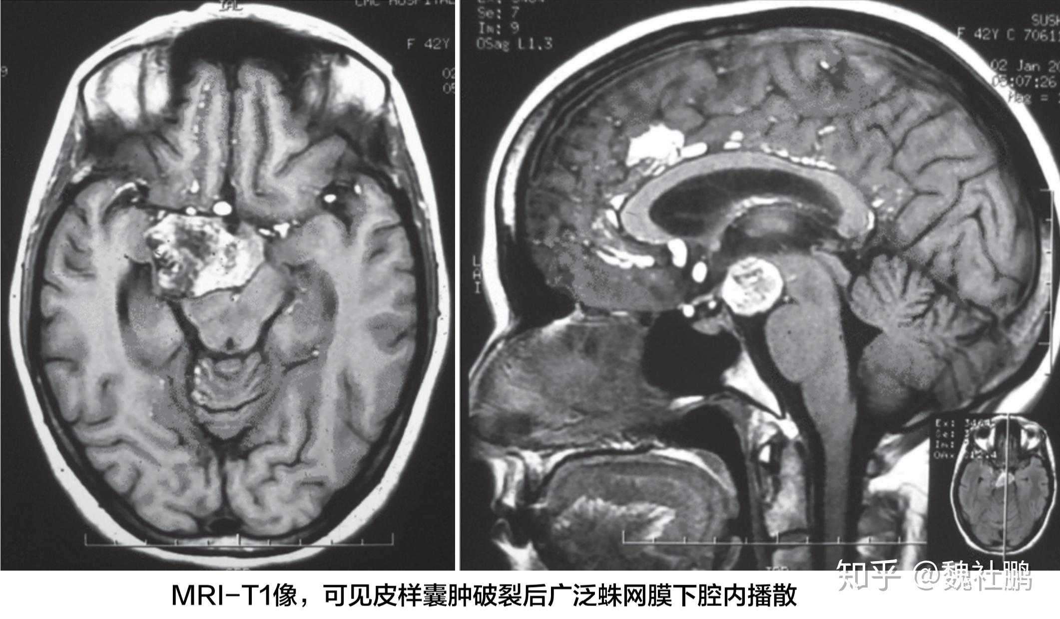 影像學表現與脂肪瘤類似:ct顯示低密度病變,mri顯示t1高信號,t2信號多