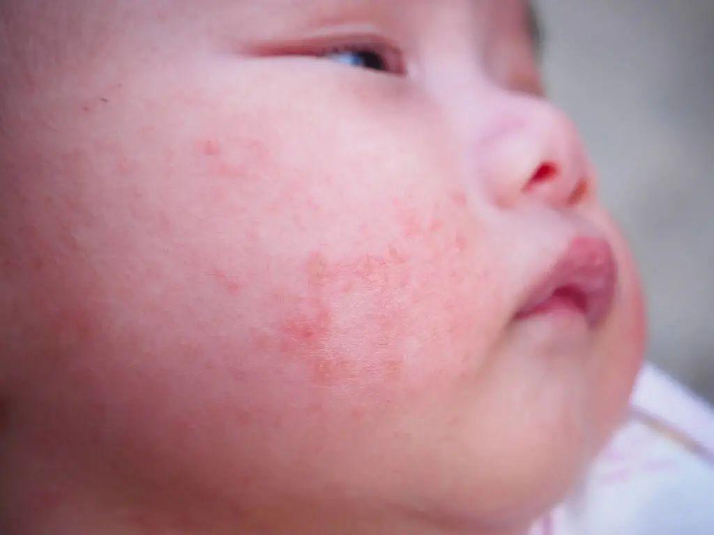 湿疹和痱子的区别图(小儿湿疹和痱子难区分？这6点不同要了解，以免孩子"受罪") | 说明书网