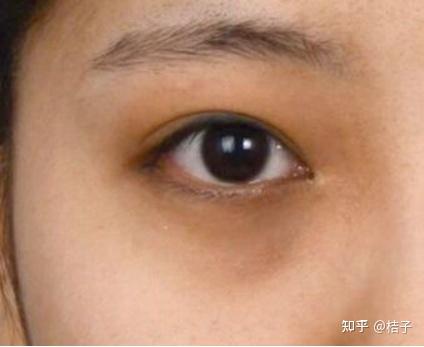 一般血管型黑眼圈的人眼睑都会比较薄,所以血管有轻微变化就很容易