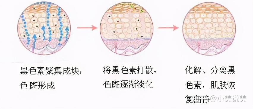 超皮秒有什麼作用只能祛斑嗎