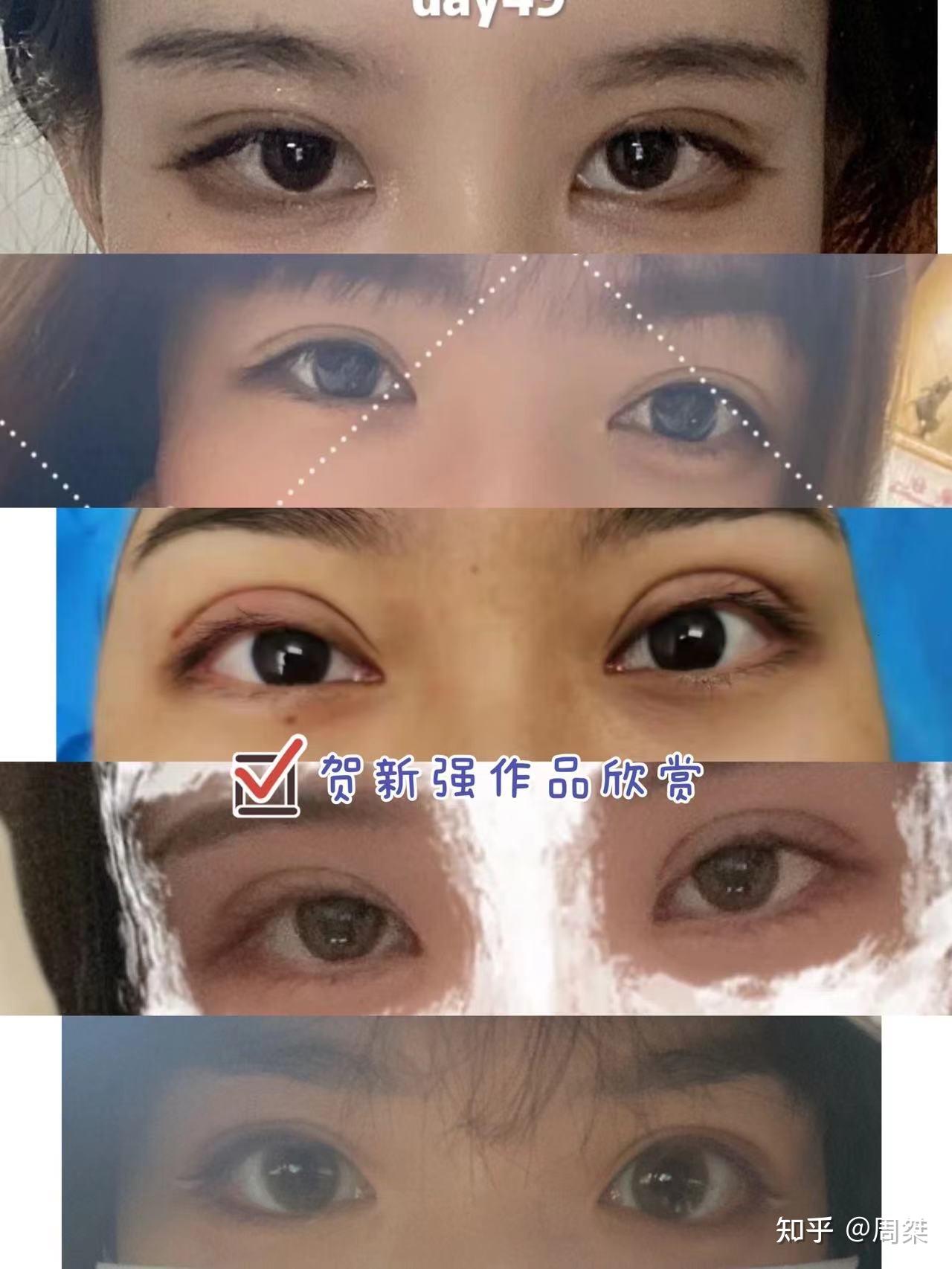 深圳做双眼皮比较好的医生有哪些? - 知乎