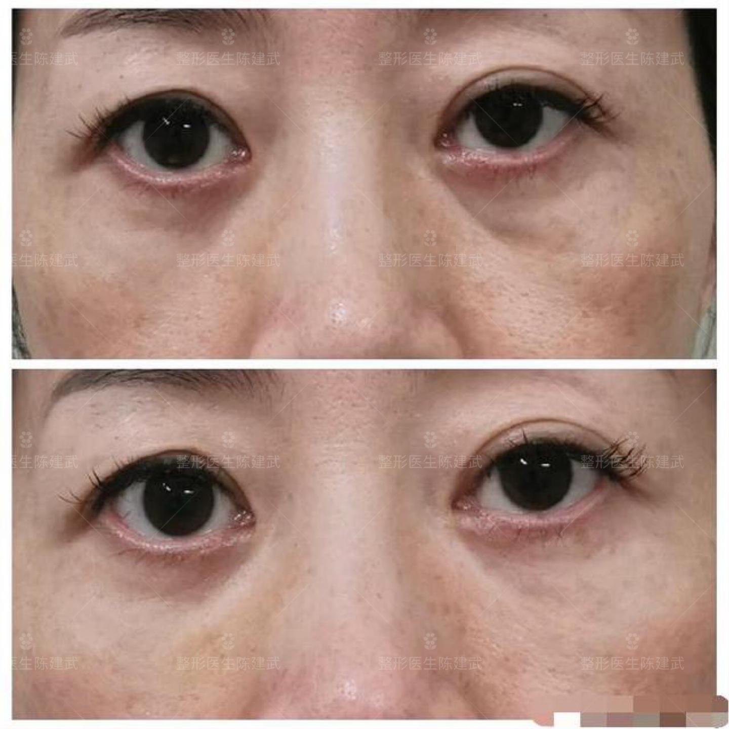 患者眼袋手术失败 找我做修复 治疗后泪沟凹陷明显改善 知乎