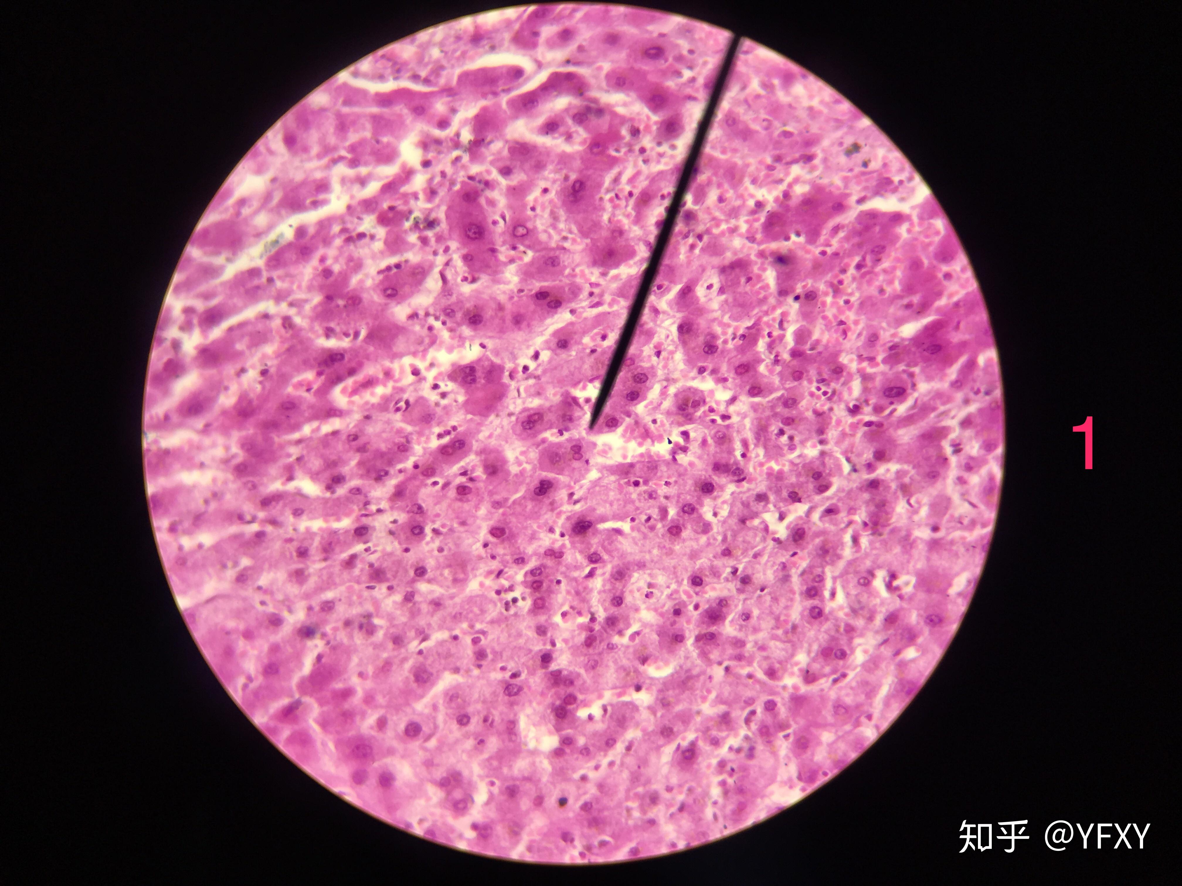 门脉性肝硬化镜下图片图片