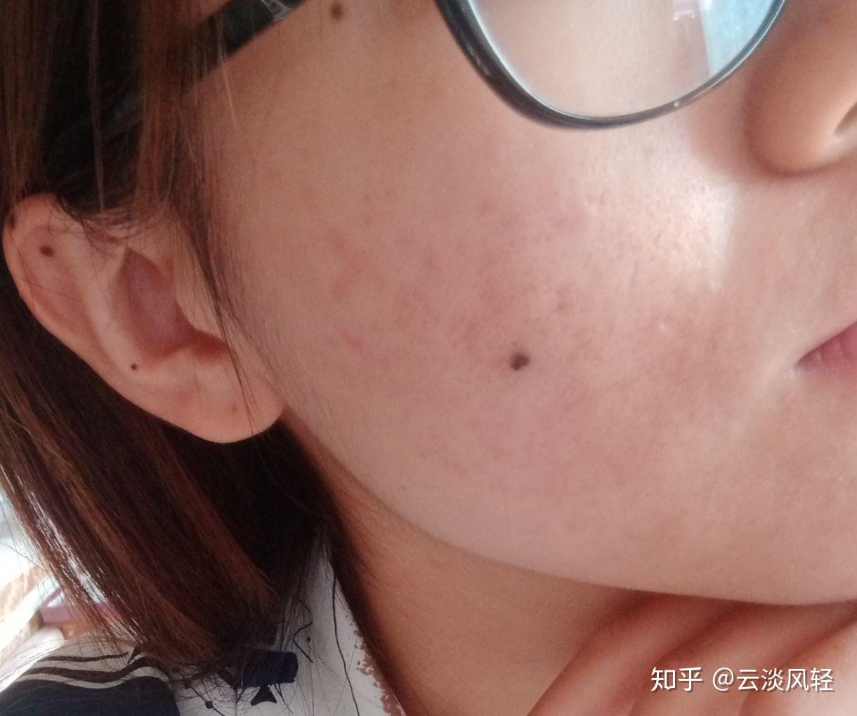 一心酸就起鸡皮疙瘩(心疼为什么会起鸡皮疙瘩)
