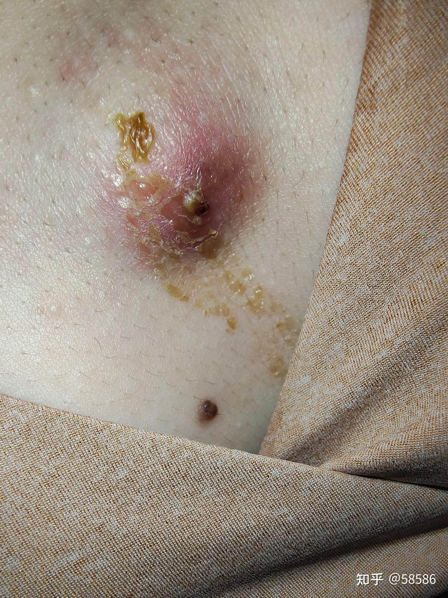 记录皮脂腺囊肿 - 知乎