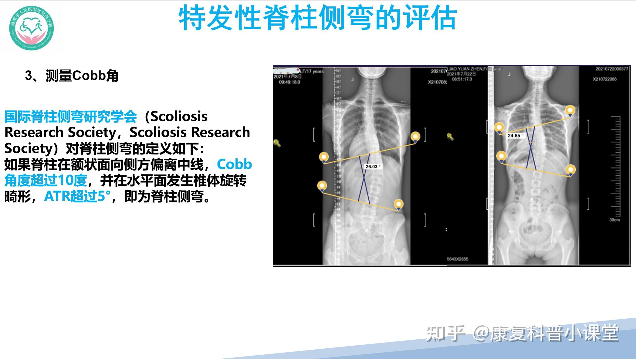 特发性脊柱侧弯的诊疗策略 - 知乎
