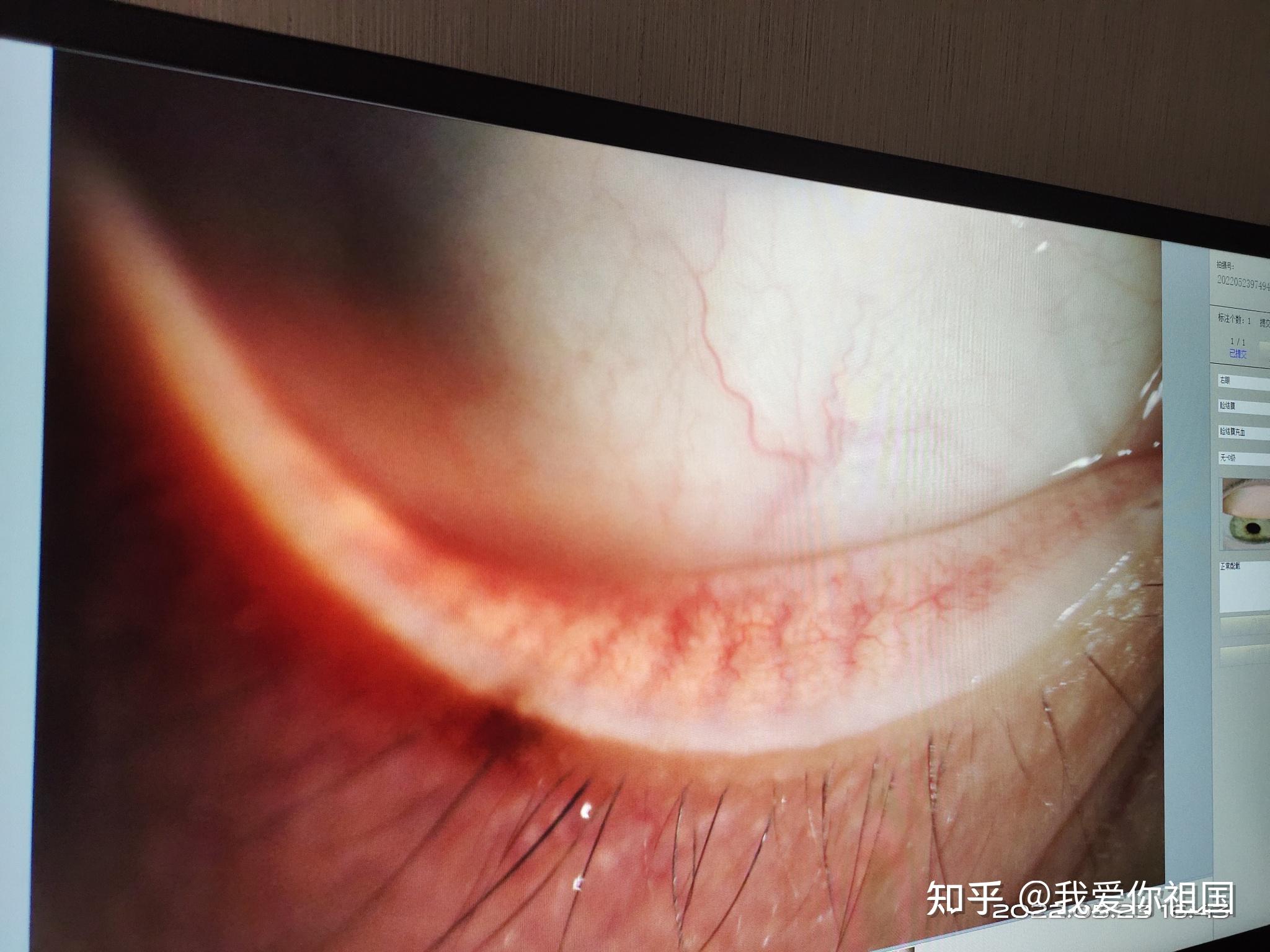 近视加散光的烦恼，该如何选择隐形眼镜。 - 知乎