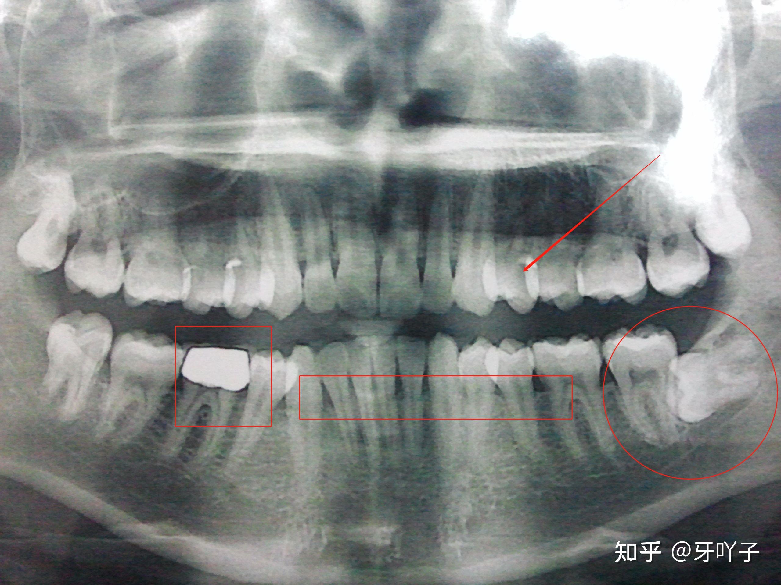 如何看牙齿x光片图片