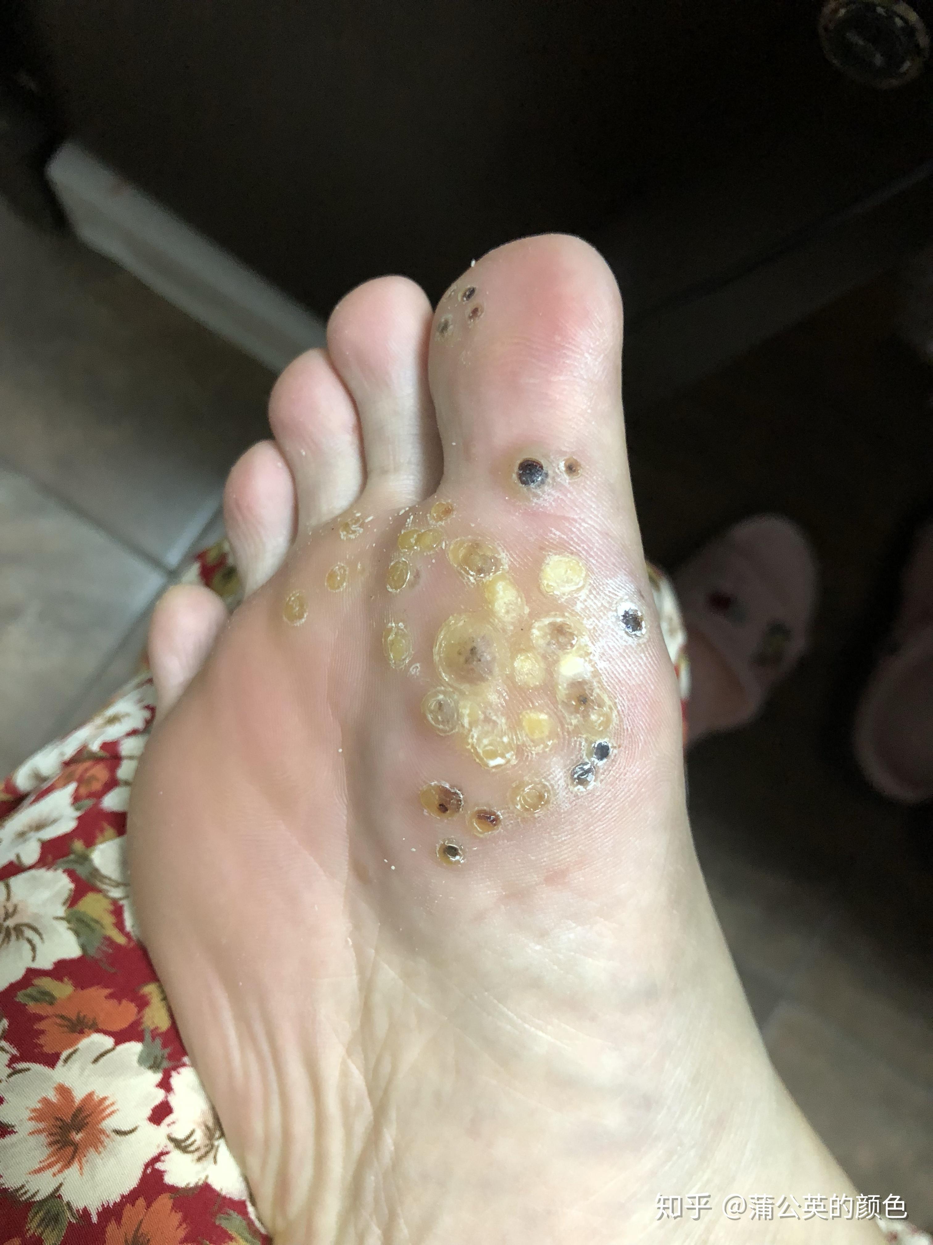 分享下一堆被当做鸡眼的跖疣,最终痊愈的过程
