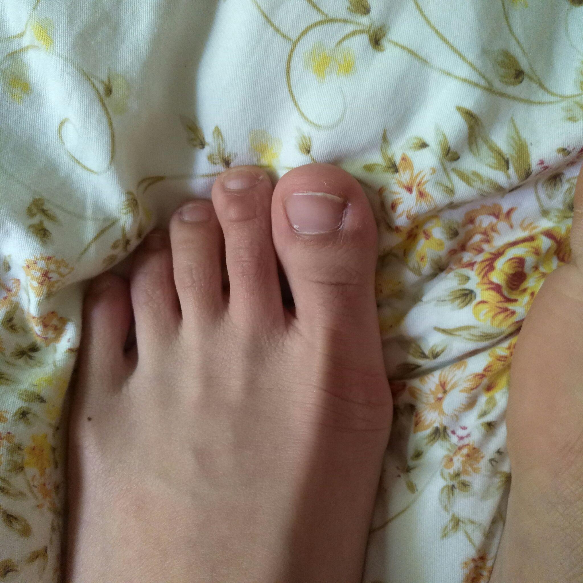 脚趾能否五指张开是基因差异吗？ - 知乎