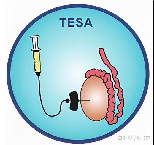 无精子症患者做国内三代试管婴儿的获取精子方式