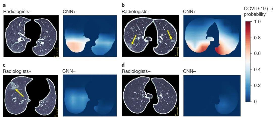 医学界巨献比核酸检测更灵活用ct模型也能鉴定新冠患者