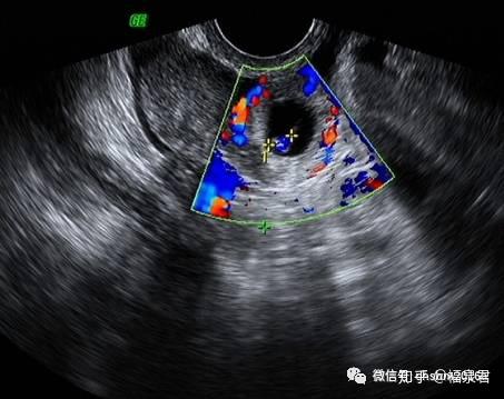 宮外孕超聲診斷超聲夢影像醫生集團ccm