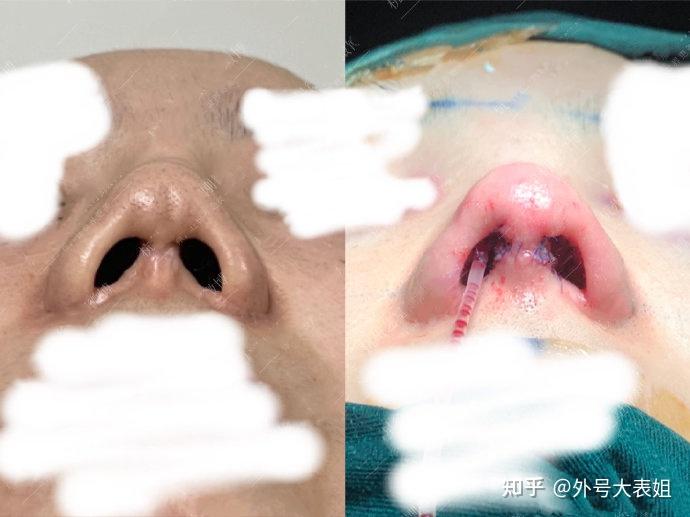 假体隆鼻 超体鼻背 肋软骨鼻尖 鼻小柱下拉 自体筋膜包裹 鼻翼软骨