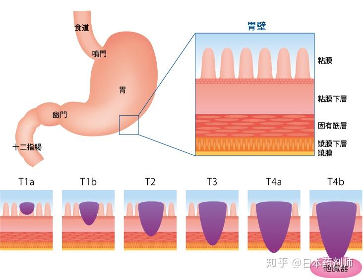 为什么总在提醒要进行胃癌的早期筛查