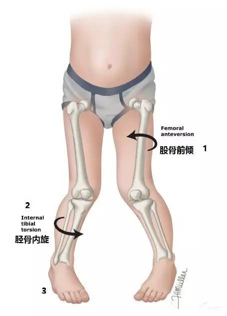 内八字腿矫正方法图解图片