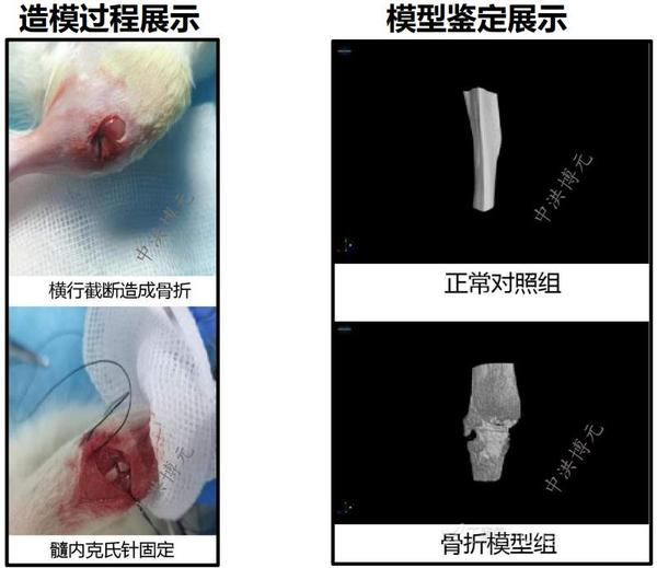 胫骨平台骨折模型 知乎