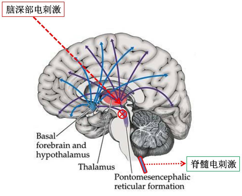 图4:脑干出血损伤了脑干网状上行激活系统和上下行的神经传导束,信息