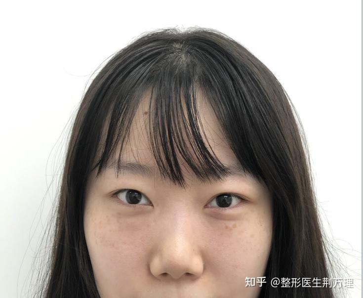 眼部美学标准丨小姐姐6mm宽度平行型双眼皮很不错